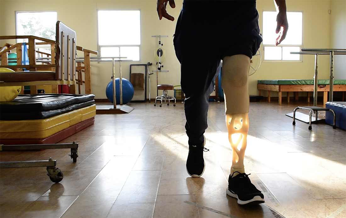 A photo of a person walking with a prosthetic, close up on legs