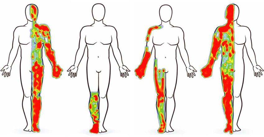 Four body maps with different distributions of green and red areas indicating pain