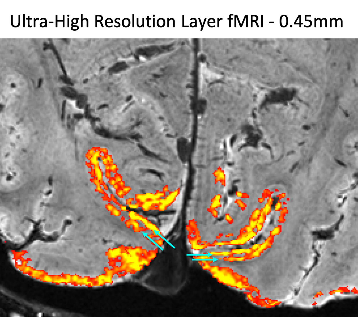 MRI of brain with some neurons highlighted in orange