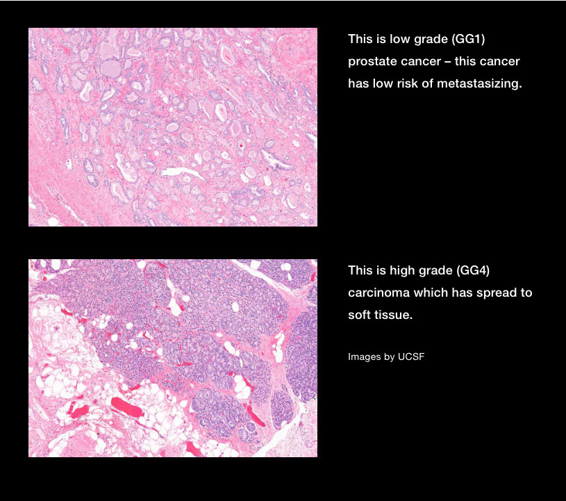 Two stained samples of prostate cancer tissue under a microscope. The top sample is more continuous and pink, and the caption readsThis is low grade (GG1) prostate cancer – this cancer has low risk of metastasizing." The bottom slide is more variated and darker, and a caption for it reads "This is high grade (GG4) carcinoma which has spread to soft tissue." 