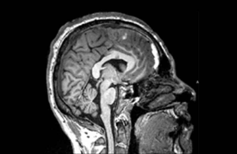 A brain scan showing a human head in profile