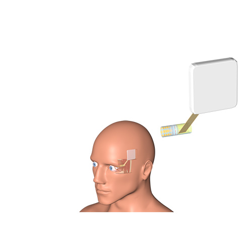 rendering of a human head showing the placement of the electrode relative to the eye