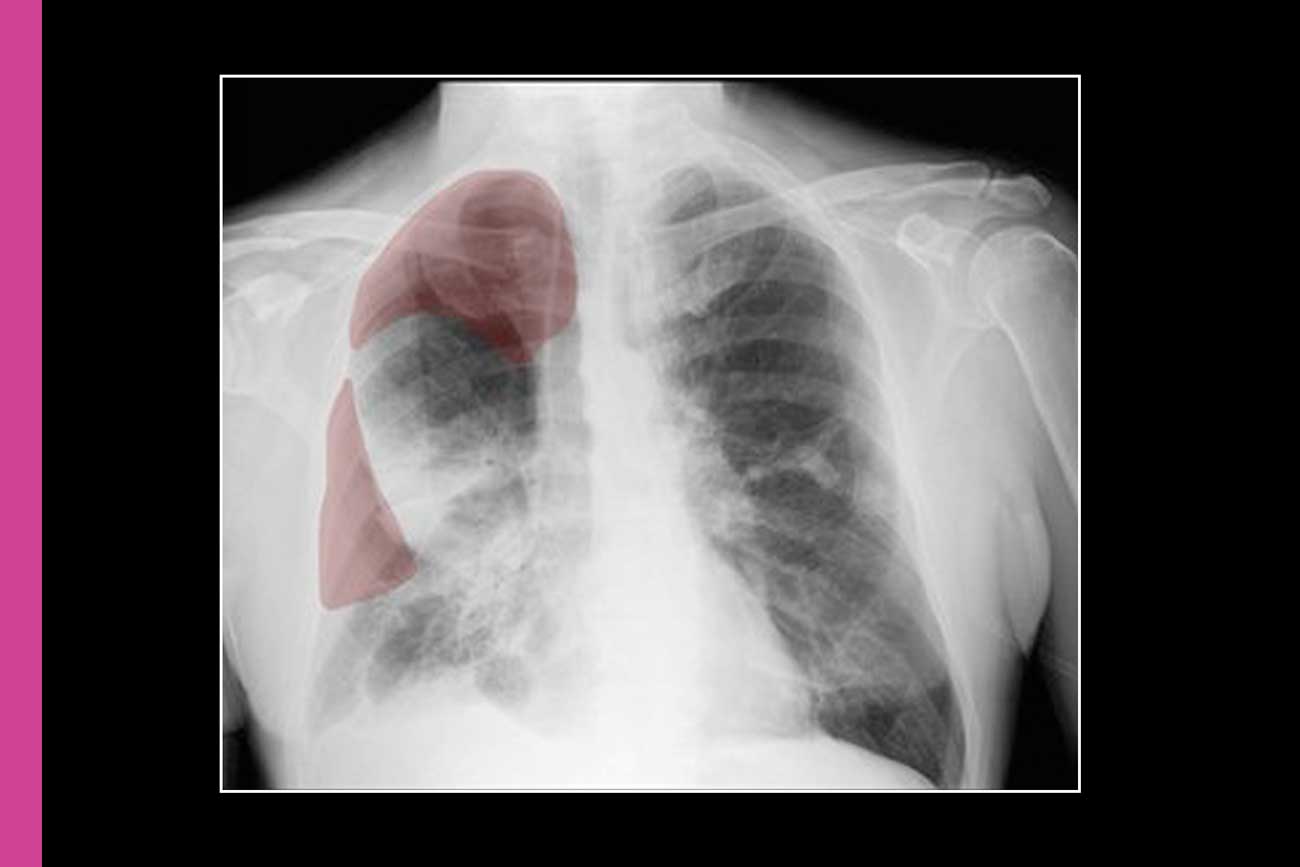 An X-ray scan of someone's chest with a lung on the left highlighted in red