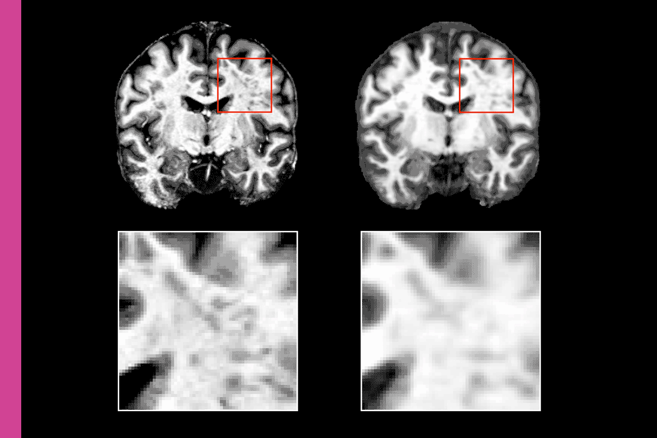 A black background with a pink border on the left shows four scans; two at the top of the full brain, two at the bottom with close-up subsections