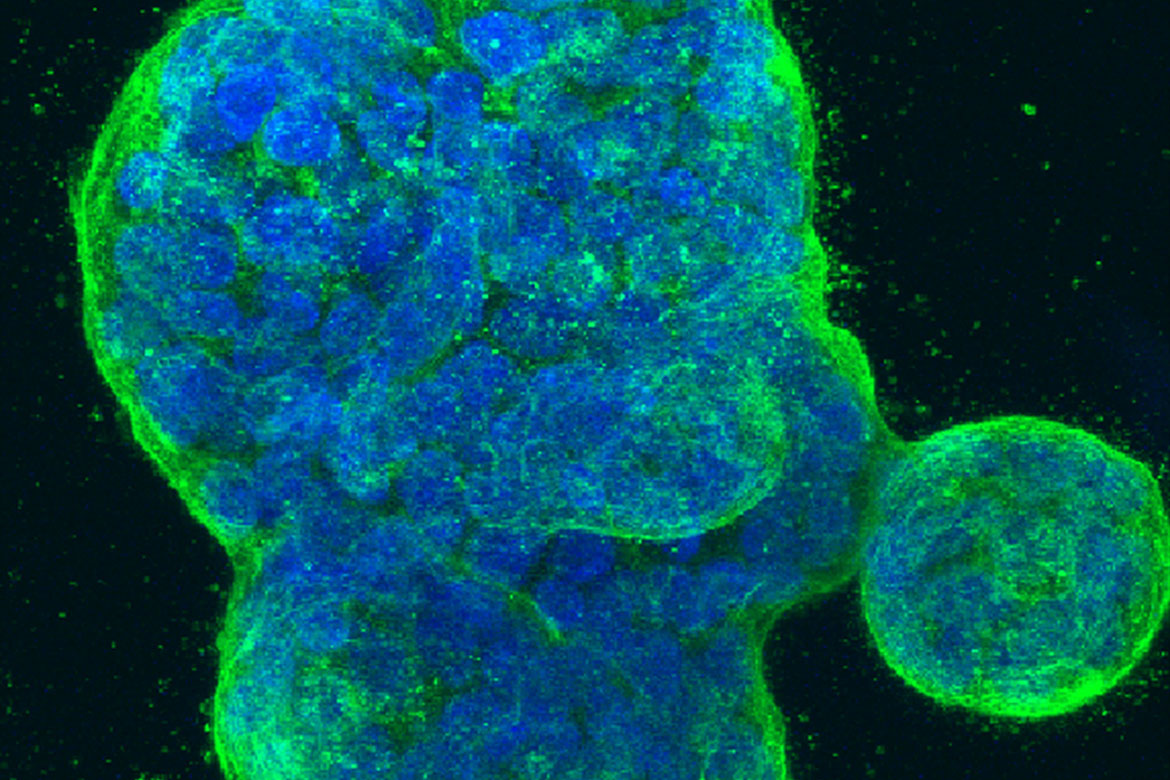 Three-dimensional culture of human breast cancer cells, with DNA stained blue and a protein in the cell surface membrane stained green.