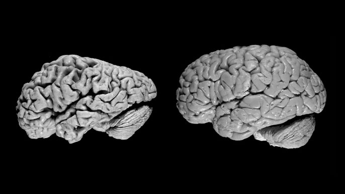 Visualization of a brain with Alzheimer's next to a brain without Alzheimer's