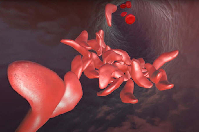 Sickle cell visualization
