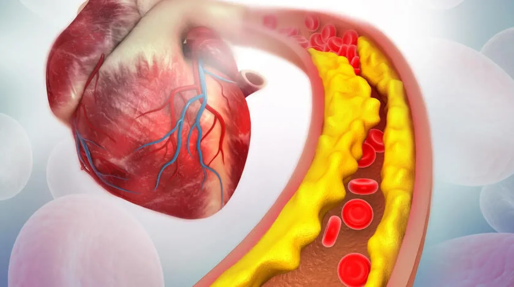 An illustration of cholesterol plaque in a human heart artery.