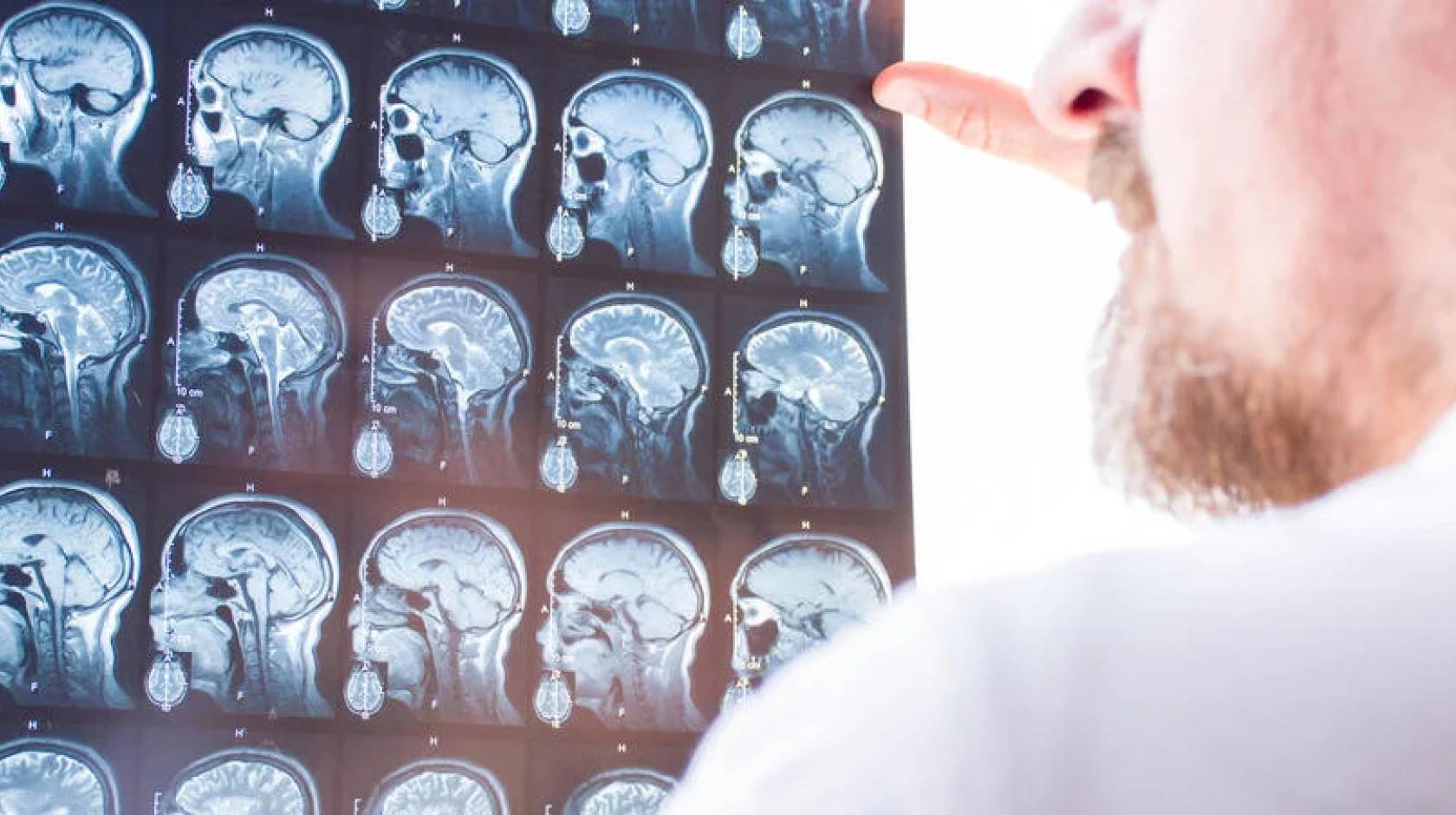 A doctor looks at a series of full brain scans on one X-ray sheet