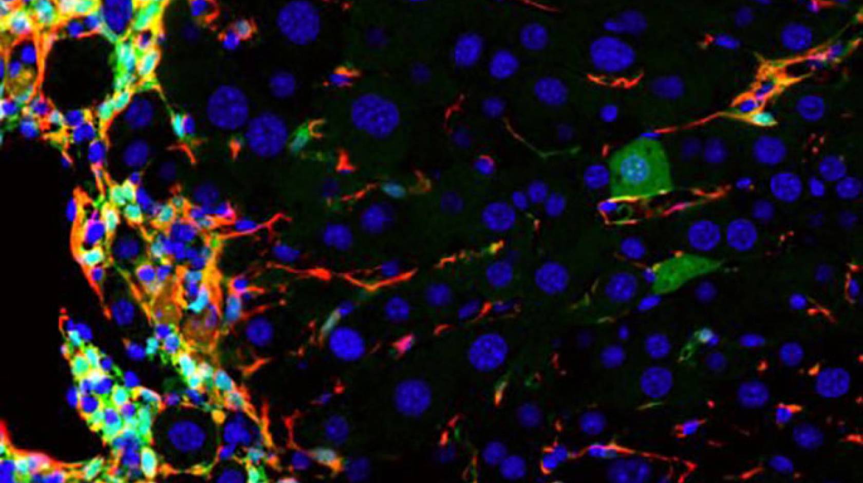 UCSF cirrhosis to healthy liver cells