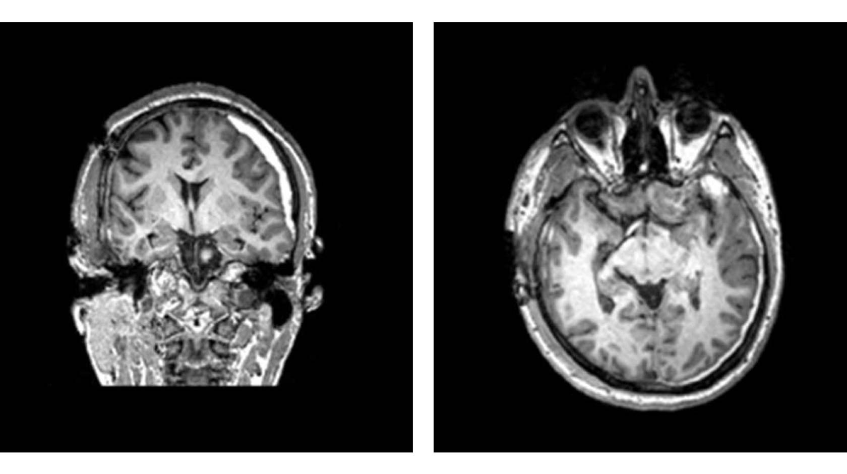 Two brain scans, one showing a human skull and brain from the back, the other from above