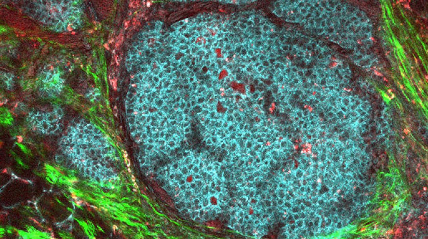 Breast cancer tumor in its microenvironment