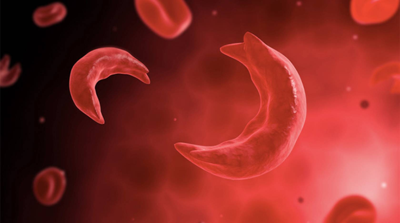 sickle cell