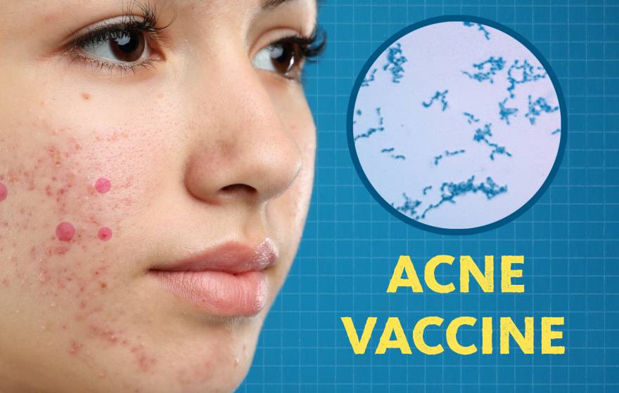 An image of a face with acne. Next to it is a microscopic view of Cutibacterium acnes. Below it are the words "acne vaccine"