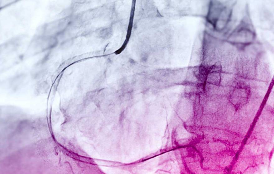 A scan in colorful purples and blues with a curved shape in the middle — an angiogram