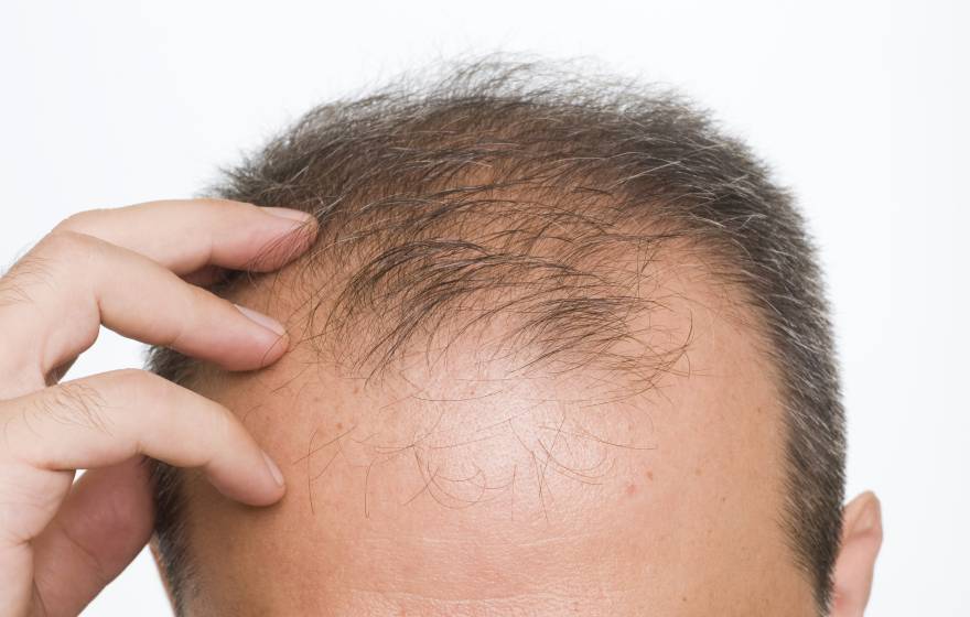 Man scratching bald head, only top of head visible