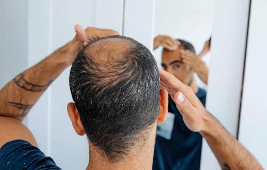 A man with thinning hair on the back and top of his head looks in the mirror, hands on his head.