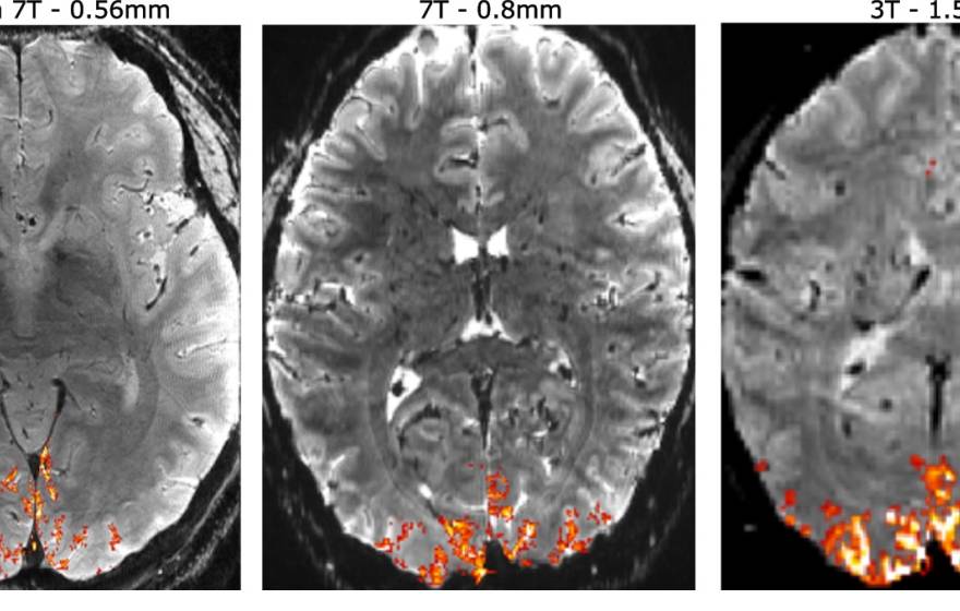 Three MRIs side by side with varying shades of orange at the bottom