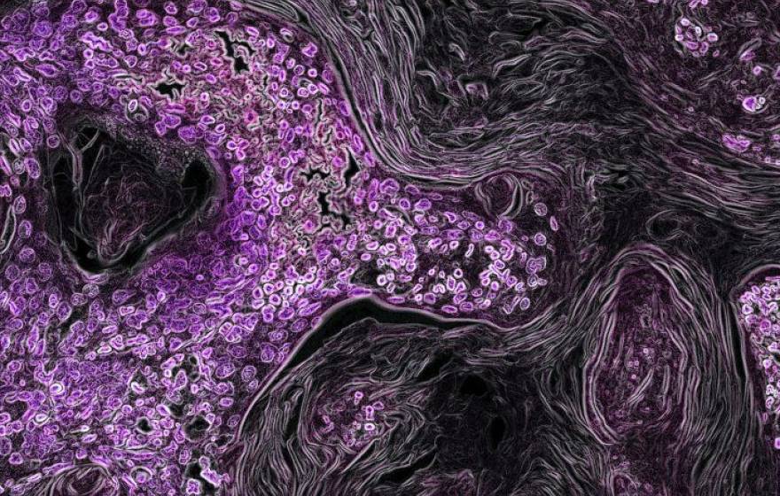 A microscopic image of KRAS-driven lung cancer (purple) in a mouse model