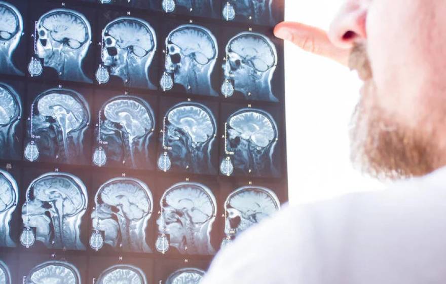 A doctor looks at a series of full brain scans on one X-ray sheet