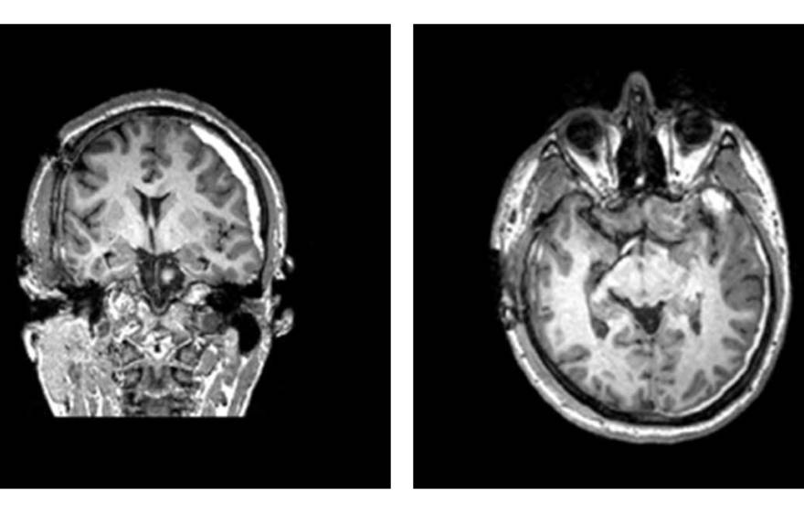 Two brain scans, one showing a human skull and brain from the back, the other from above