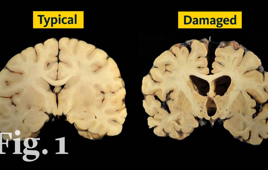 Two cross-section slices of brains. The slice on the left is labelled NORMAL and the slice on the right is labeled DAMAGED, and is shrunken and shriveled. 