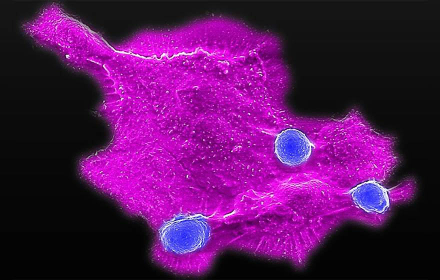 Fluorescence microscopy image showing a large magenta-colored breast cancer cell interacting with three smaller blue immune cells against a black background. The cancer cell has an irregular shape with extended protrusions, while the round immune cells appear to be attached to its surface.