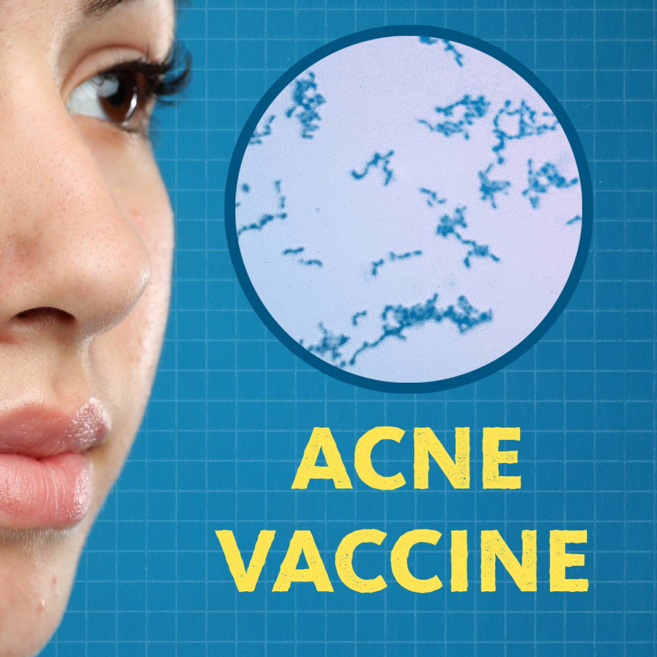 An image of a face with acne. Next to it is a microscopic view of Cutibacterium acnes. Below it are the words "acne vaccine"