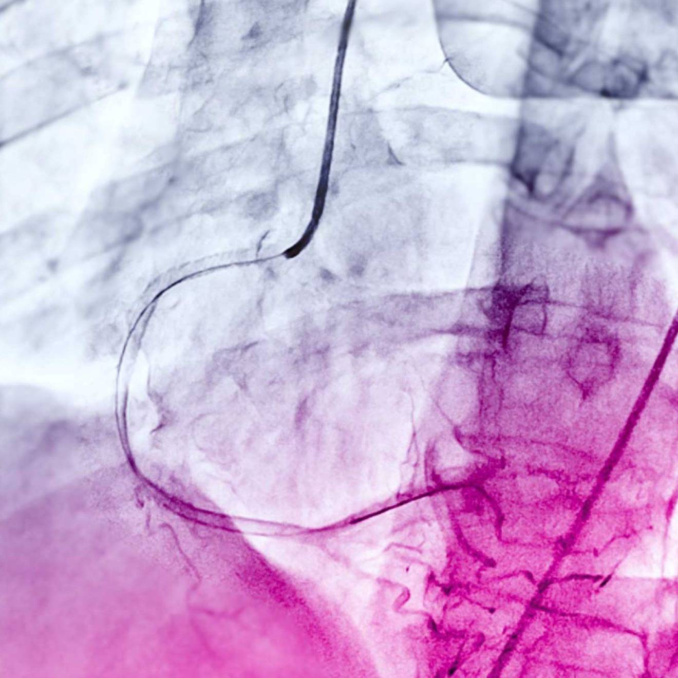 A scan in colorful purples and blues with a curved shape in the middle — an angiogram