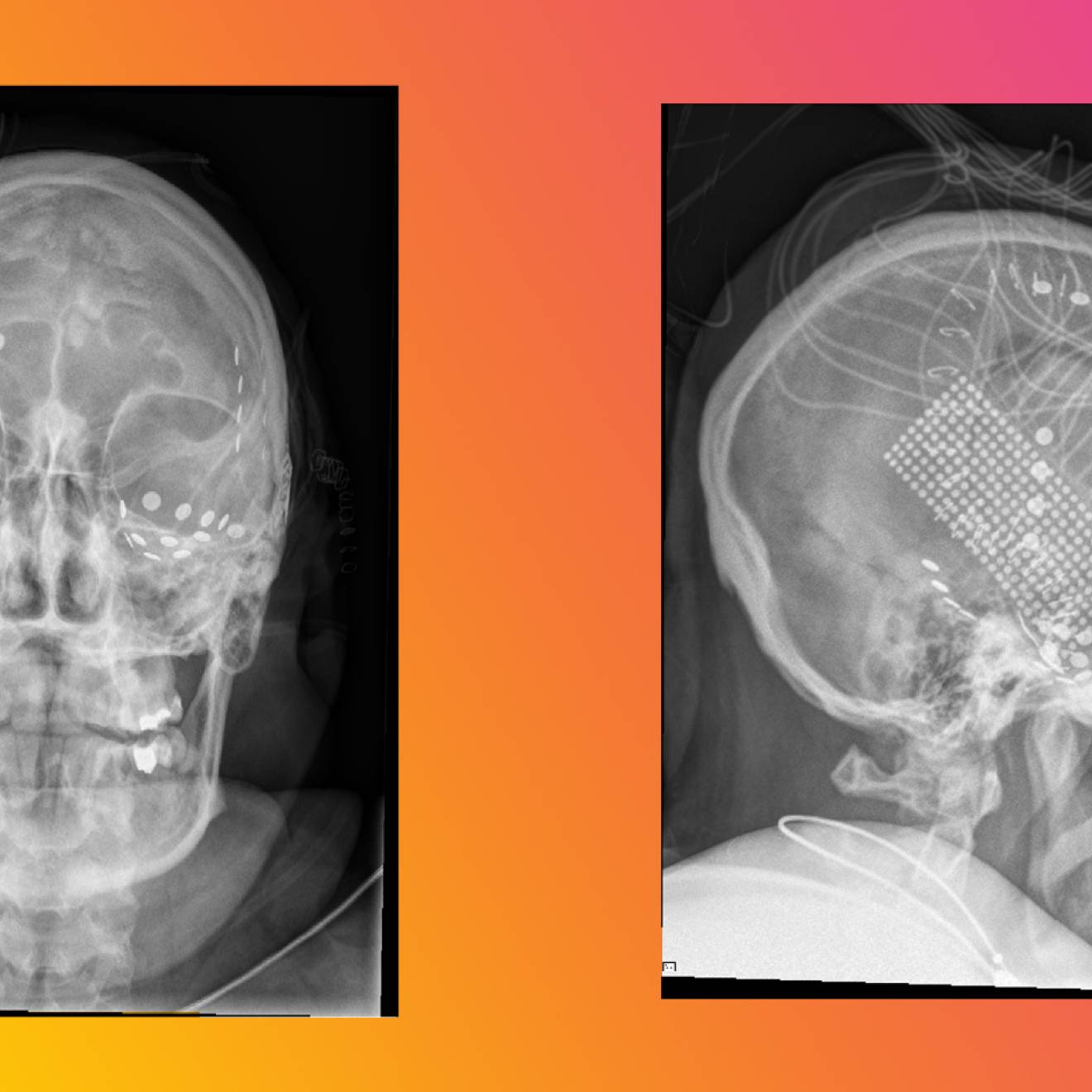 Head X-rays of subjects in the experiment