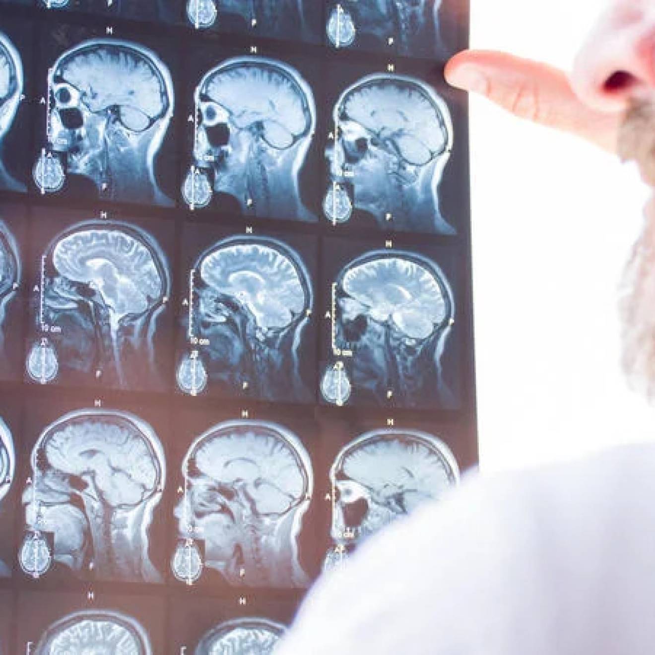 A doctor looks at a series of full brain scans on one X-ray sheet