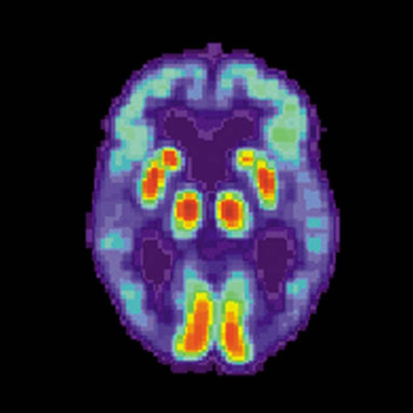 Alzheimer's disease as shown in a brain PET scan