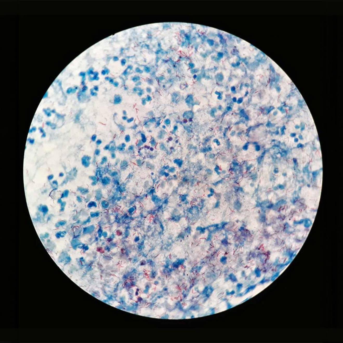 A microscope view of tuberculosis