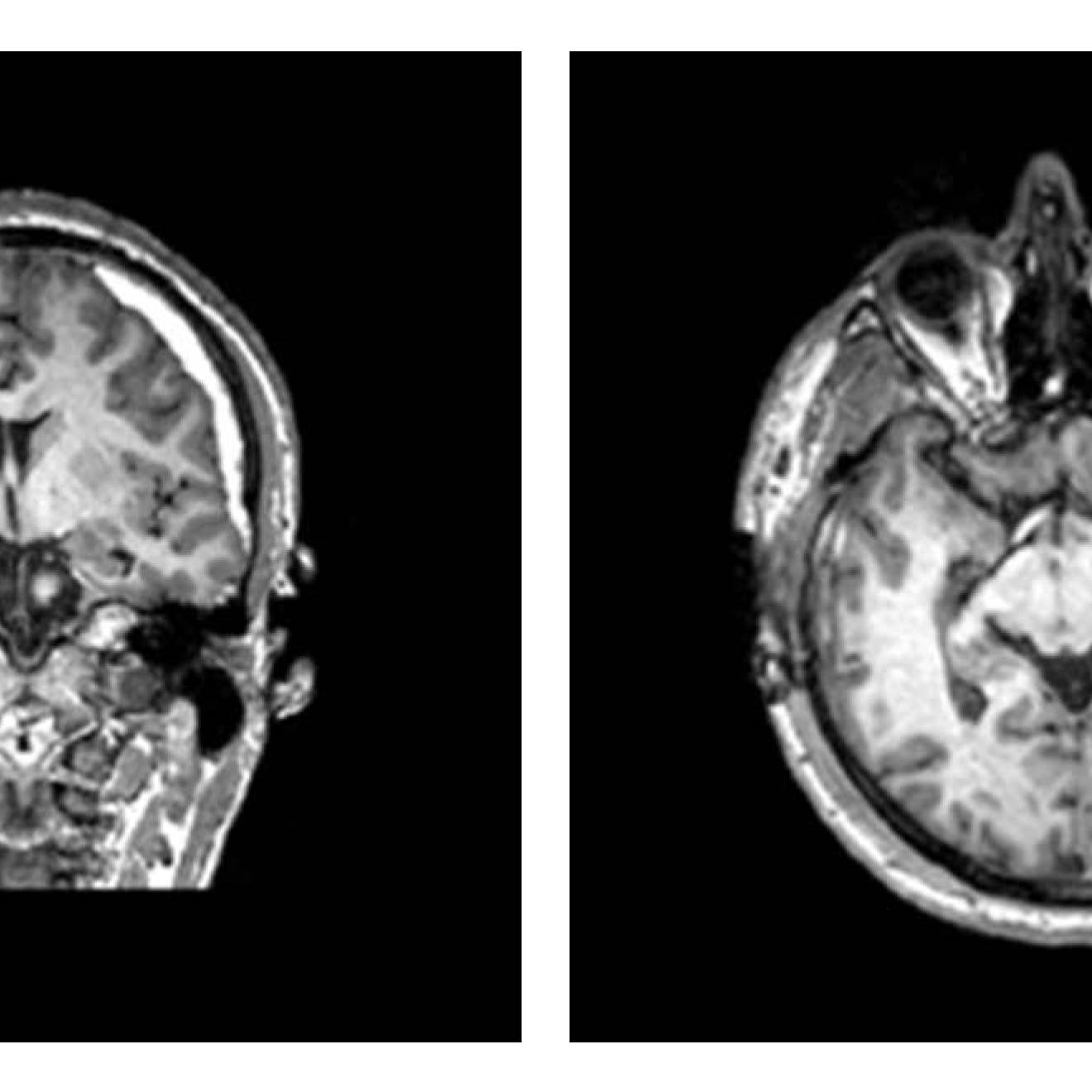 Two brain scans, one showing a human skull and brain from the back, the other from above