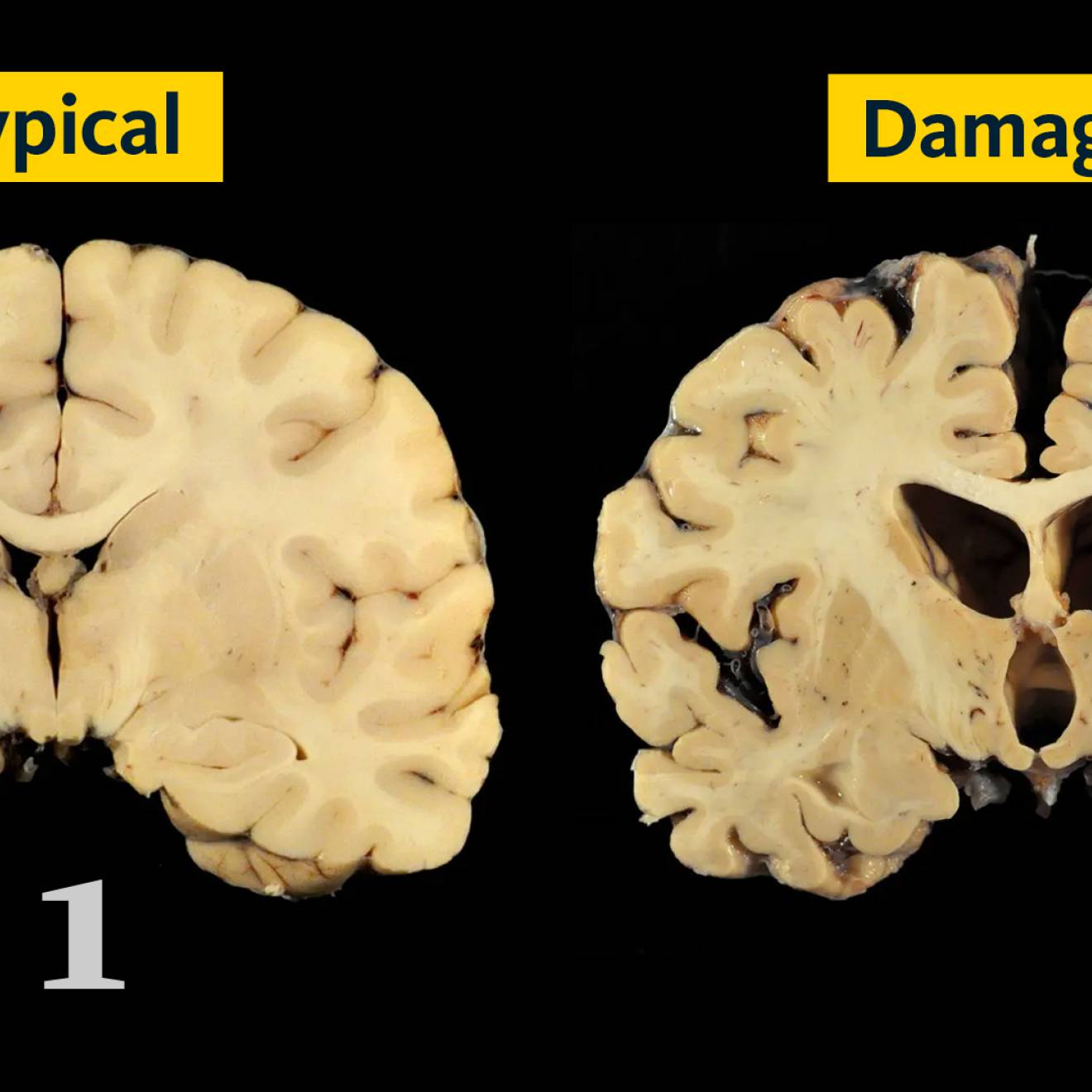 Two cross-section slices of brains. The slice on the left is labelled NORMAL and the slice on the right is labeled DAMAGED, and is shrunken and shriveled. 