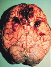 photo of human brain with blood clots